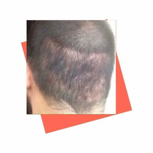 избыточное использование донорской зоны после пересадки волос