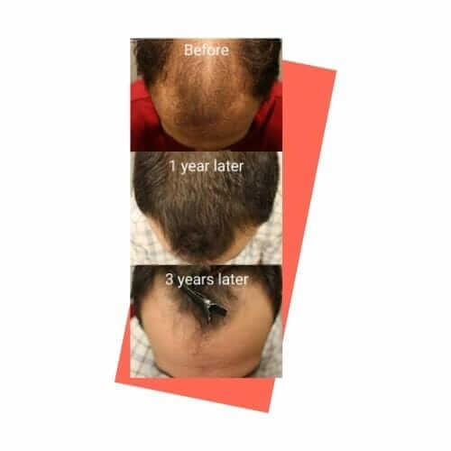Долгосрочные неудачи при пересадке волос (3 года)