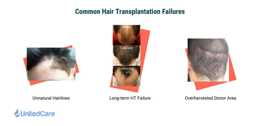 Haartransplantation ohne Operation