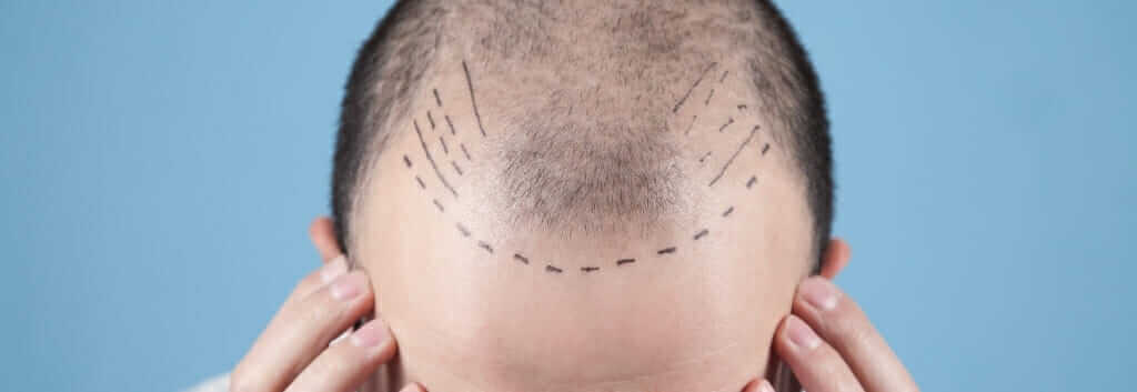 Haarausfall Haartransplantation