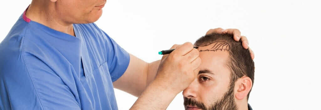 hair transplant surgeon drawing the hairline in pre-op