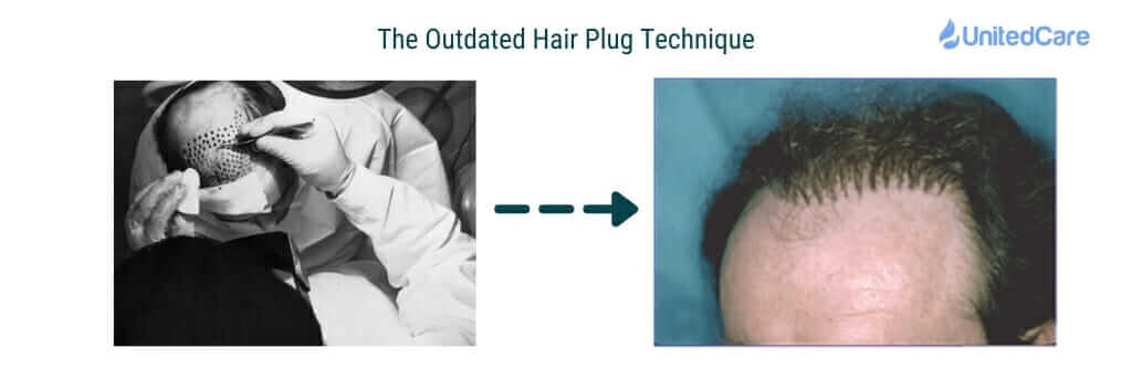 hair plug vs fue
