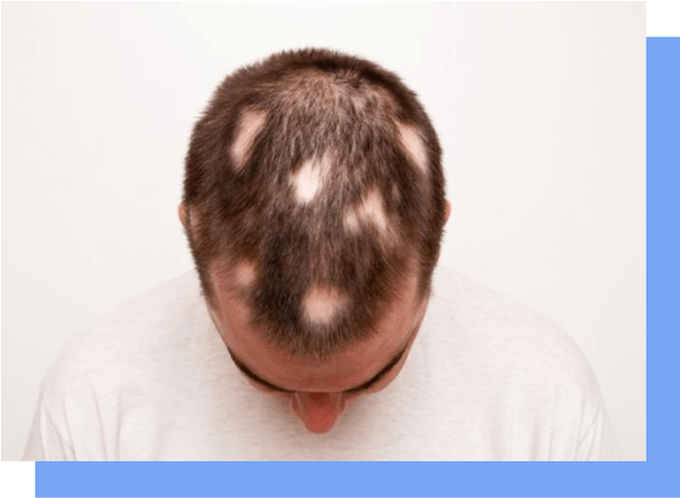 Alopecia areata Haarausfall Zeichen