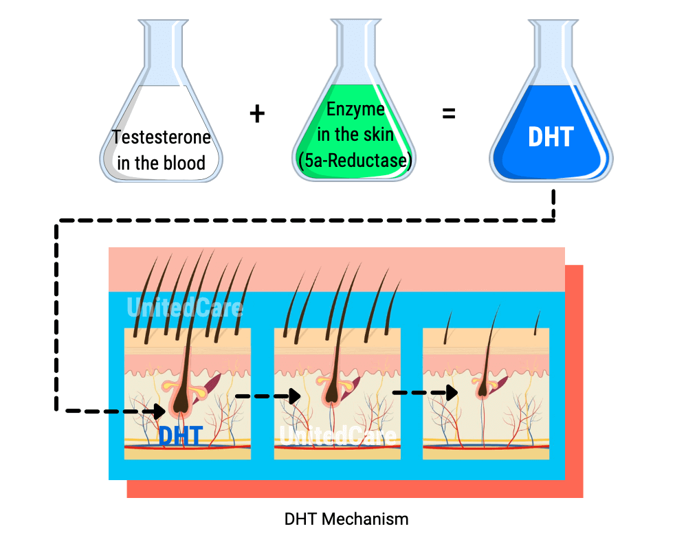 Testosterone, 5α-reductase, DHT and Hair Loss Mechanisms