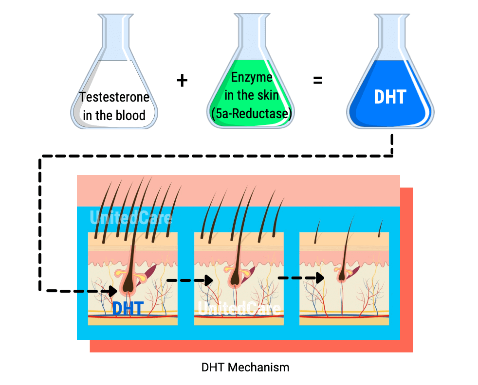 androgenic alopecia (AGA) DHT Mechanism and hair growth cycle