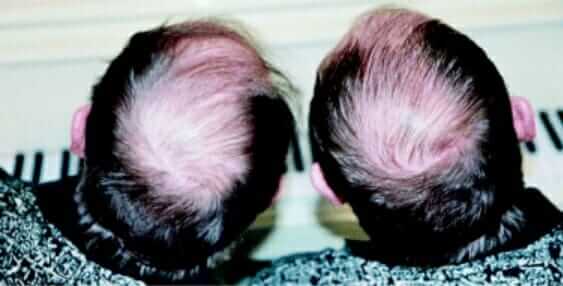 genetic hair loss