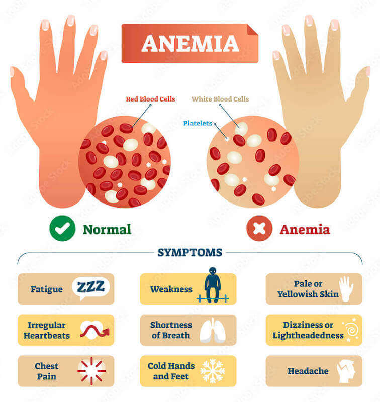 Iron Deficiency Anemia Definition and Symptoms