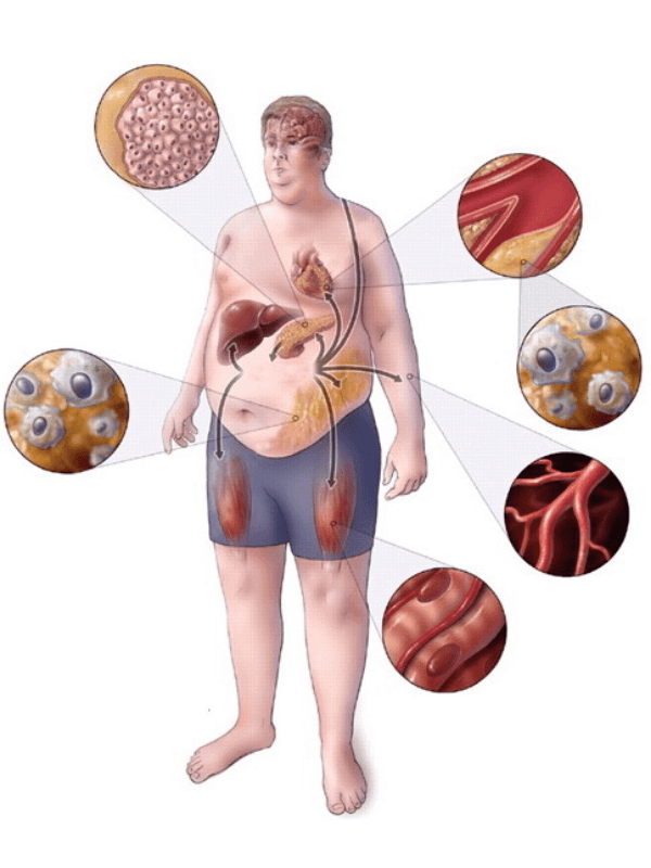 hair loss and metabolic syndrome