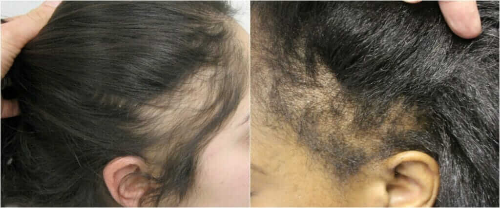 tractional alopecia hair loss