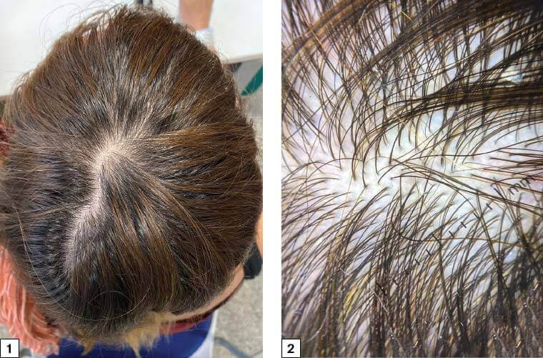 telogen effluvium hair loss signs