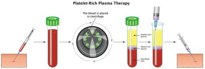 PRP Stages: Withdrawal, Centrifugation, Injection