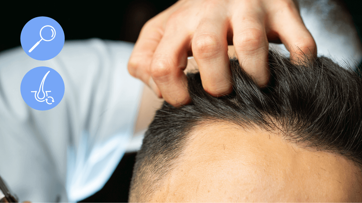 6 Accurate Signs of Balding - how to tell if you're going bald
