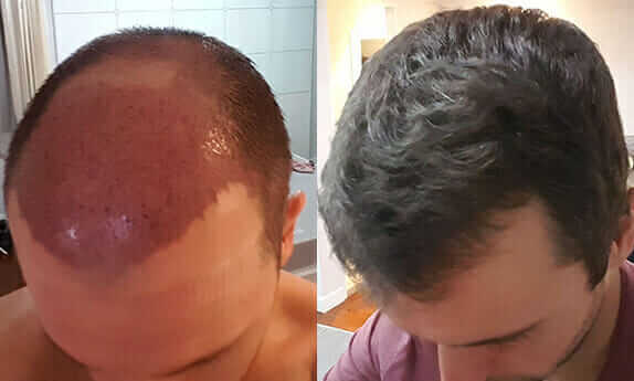 fut before and after