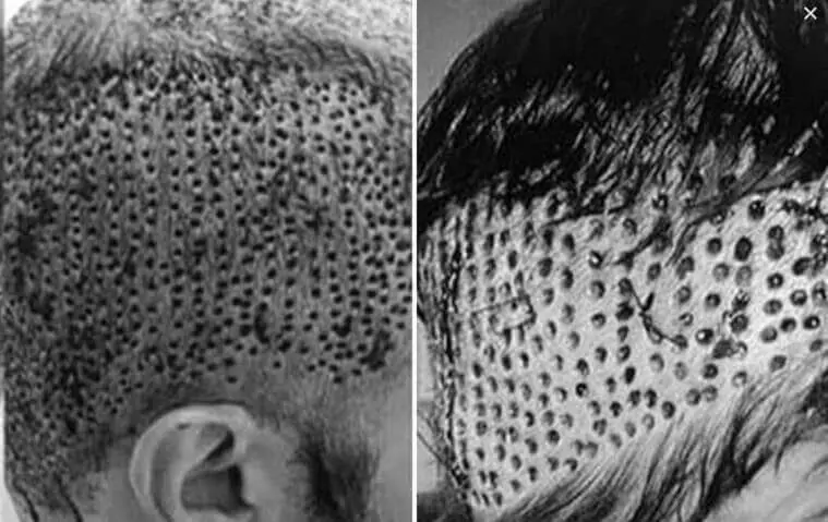 Hair Transplant Trypophobia  How to Deal With Trypophobia