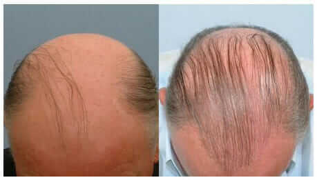 Ein Haartransplantationspatient mit einer großen Glatze und begrenzten Spenderbereichen