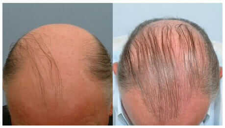 Failed Hair Transplant Can You Avoid or Fix It  DR Emrah CINIK