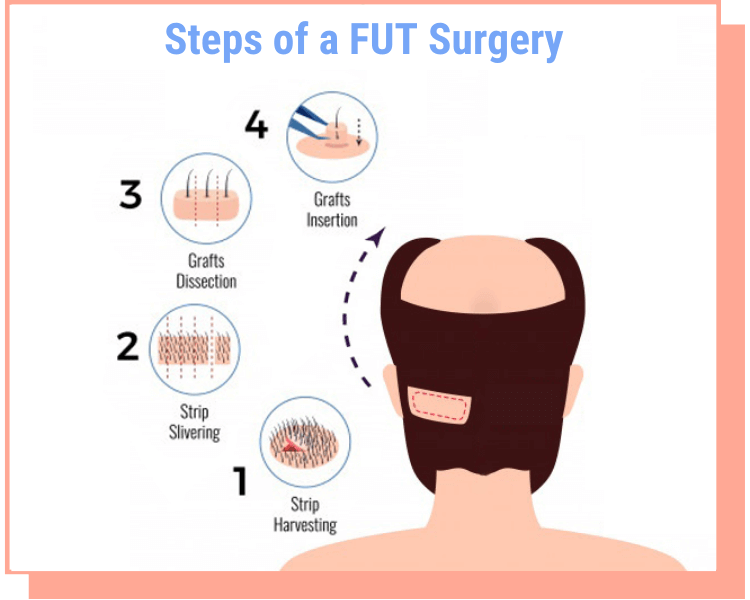 steps of a fut surgery