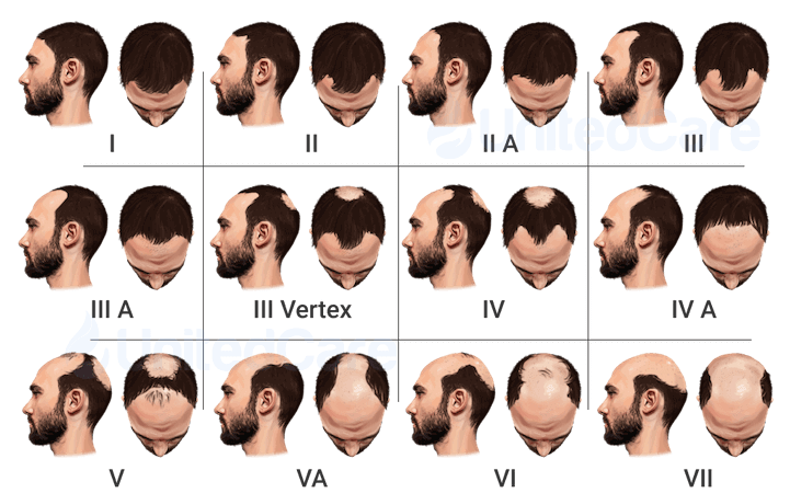 The Hamilton-Norwood Scale for Classification of Male Pattern Baldness