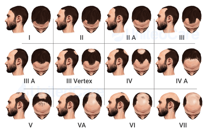 Hamilton-Norwood Scale