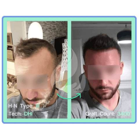 FUE before and after 2