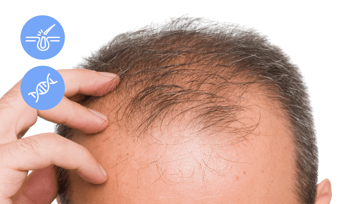 male pattern baldness