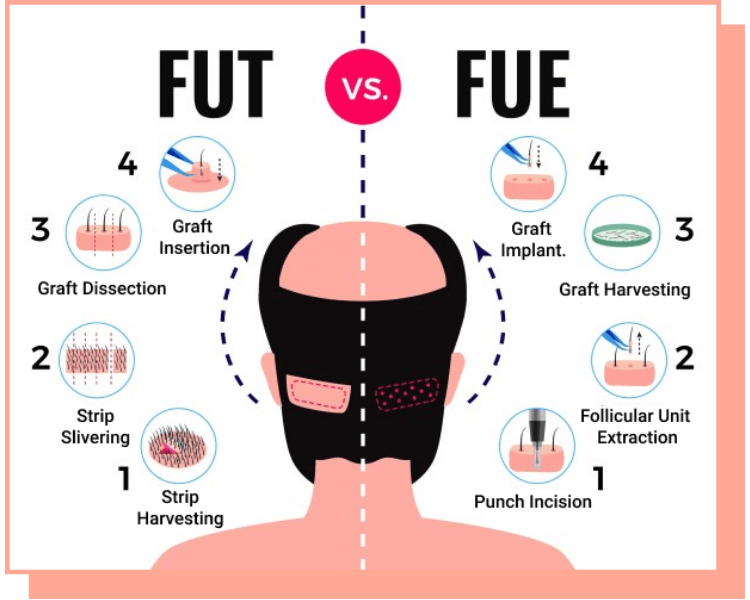 do FUE hair transplant work