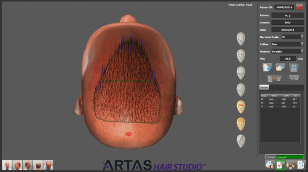 Artas transplant robot user interface