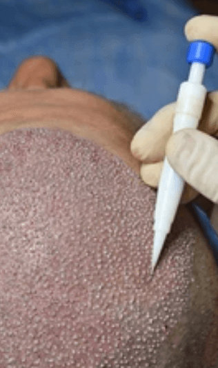 DHI pen hair transplant technology