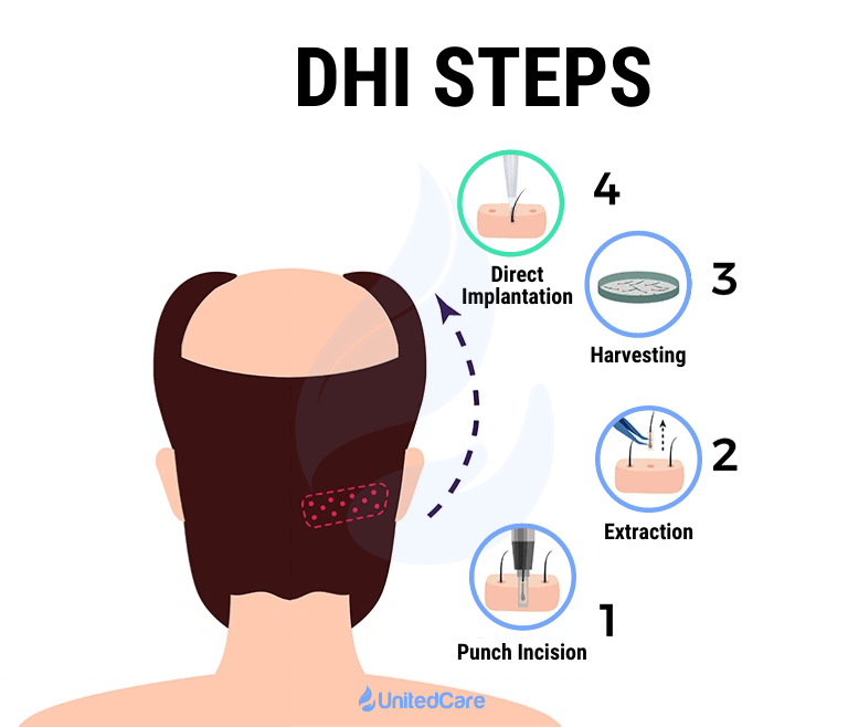 Schritte einer DHI (Direct Hair Implantation) Operation