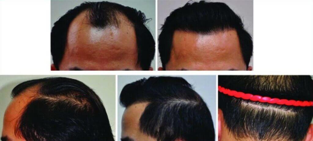Before and 10 months after FUT hair transplant procedure; 3,066 grafts, with small strip scar on donor area.
