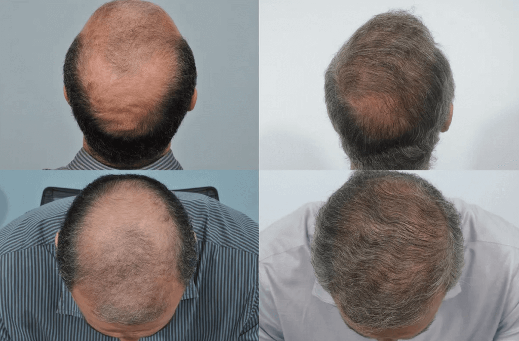 Hair transplant result 10 years after the operation