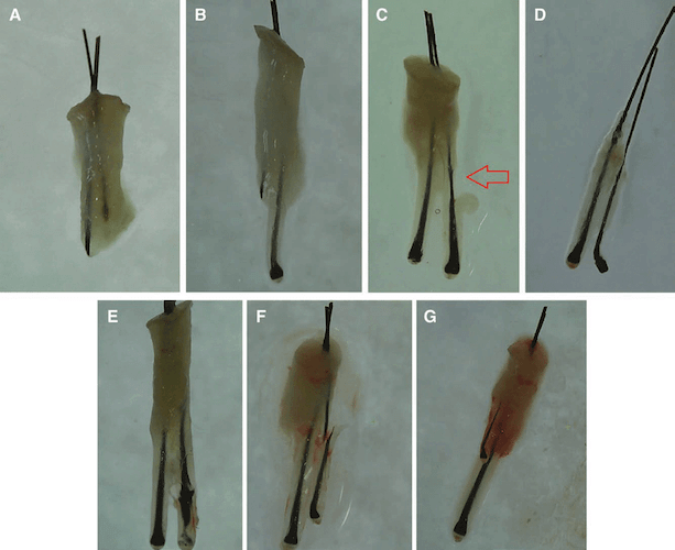 The probable hair follicle damages in FUE, total transection, partial transection, paring, an injury, bulb injury, fracture, telogen