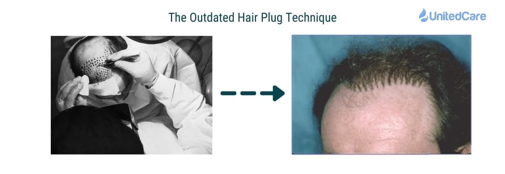 The hair plug operation and “Doll’s Hair” result
