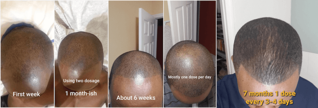 Rogaine/Minoxidil Before After