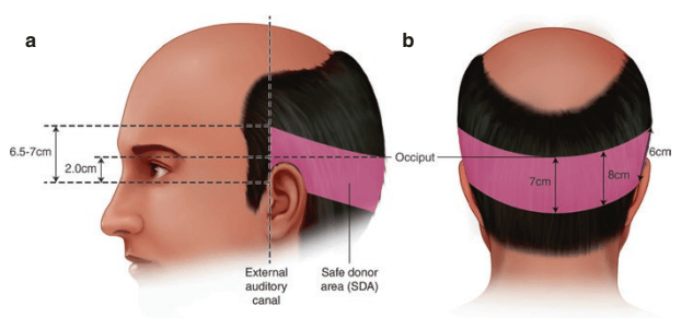 Haartransplantation Sicherer Spenderbereich
