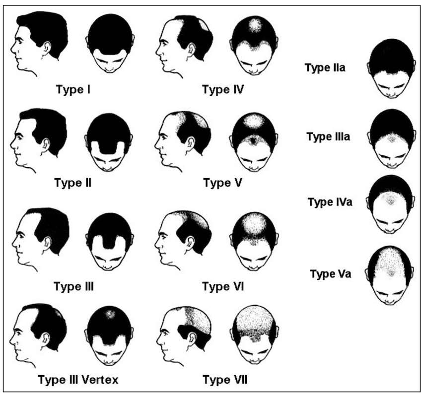 Классификация мужского выпадения волос по Гамильтону-Норвуду