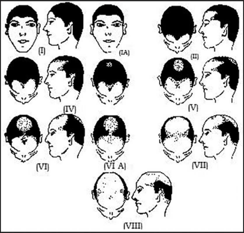 Гамильтоновская классификация мужского выпадения волос. Тип III из-за многочисленных разновидностей.
