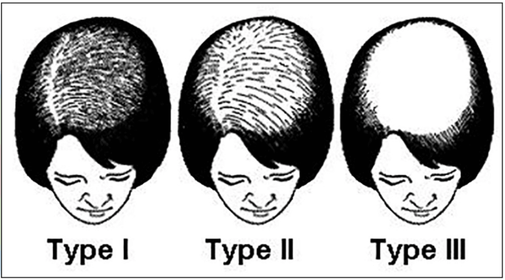 Ludwig Klassifikation des weiblichen Haarausfalls.
