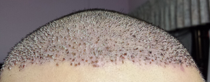 hair transplant scabs