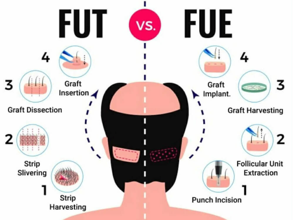 FUT vs FUE