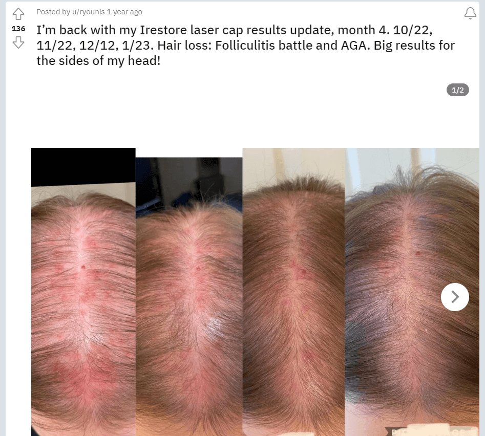 Laser Caps for Hair Growth - do they actually work? - UnitedCare