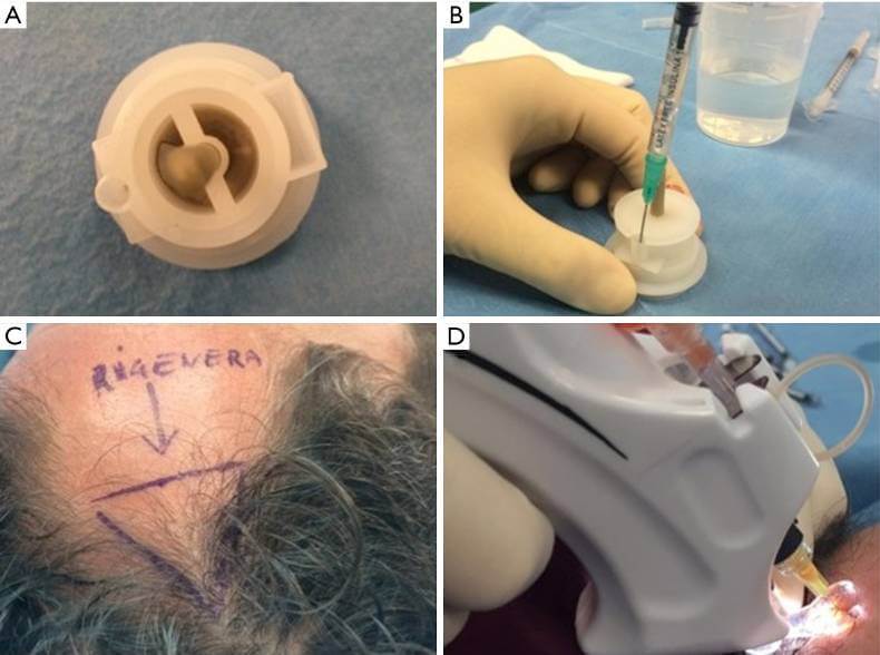 stem cell injection hair loss