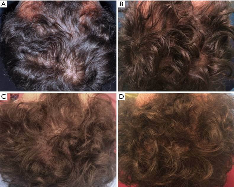 Stammzellen-Haarausfall vor und nach