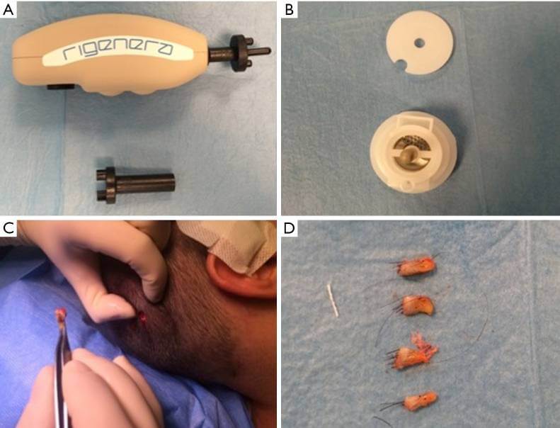 stem cell harvesting hair loss