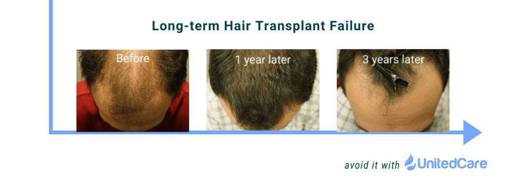 Haartransplantation ungleichmäßiger Haaransatz