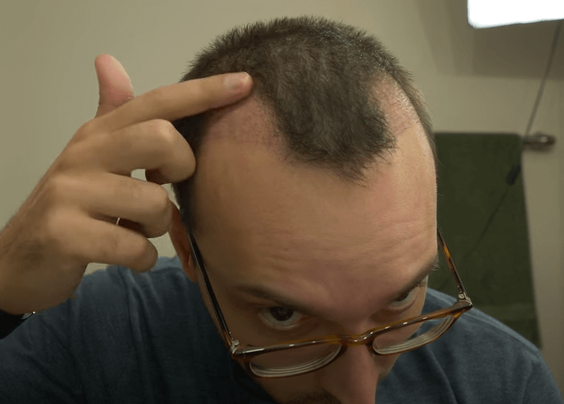 failed hair transplant 11 days after