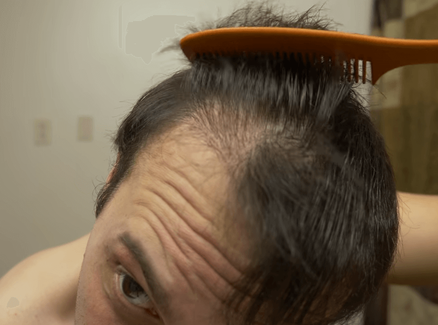 failed hair transplant 9 months after