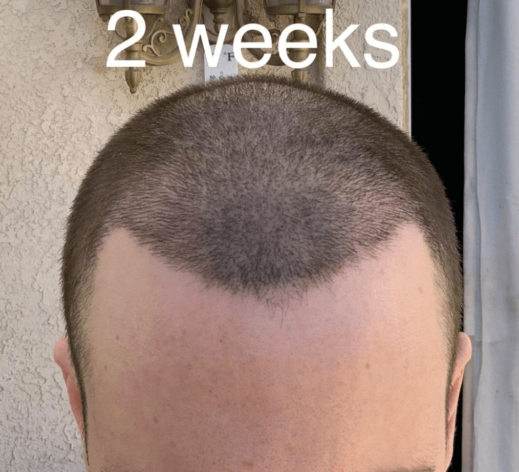 failed hair transplant 2 weeks after