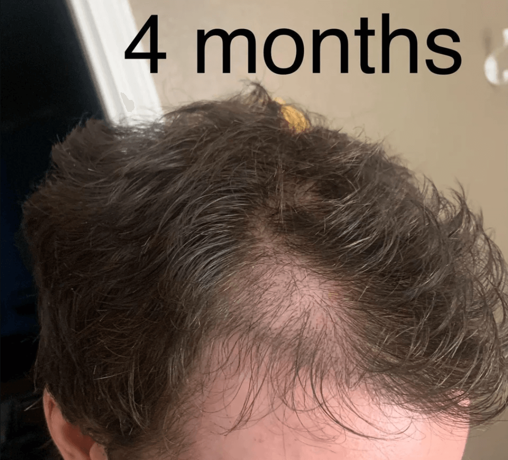 failed hair transplant 4 months