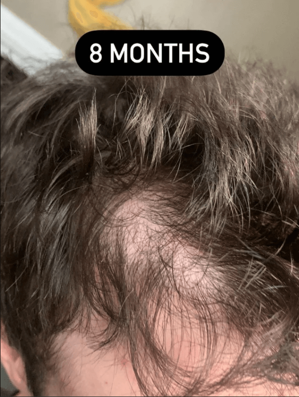 failed hair transplant 8 months after surgery